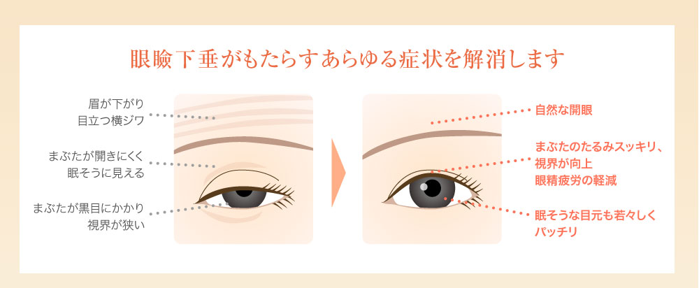眼瞼下垂がもたらすあらゆる症状を解消します