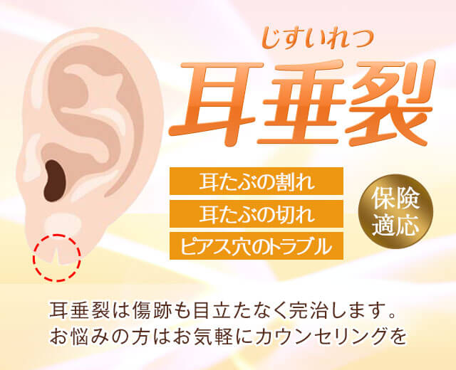 耳垂裂